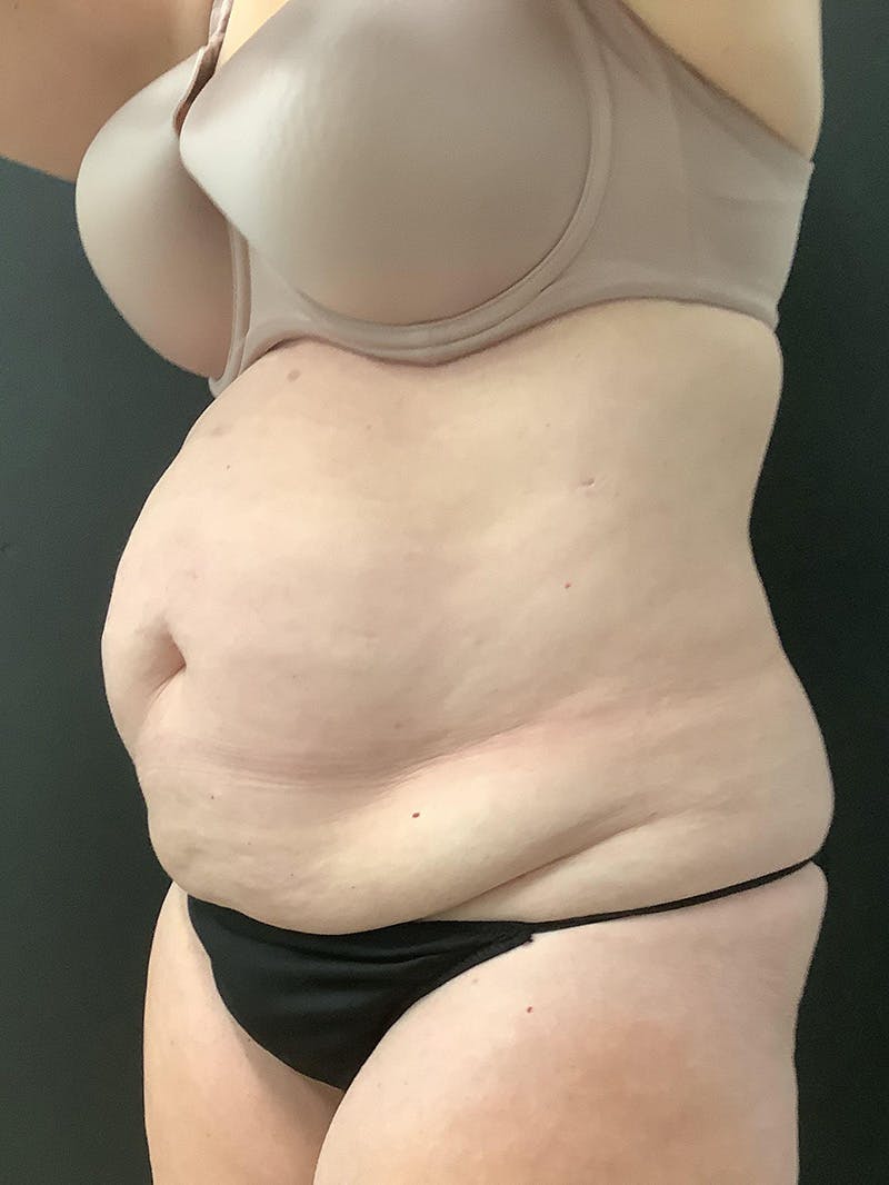Abdominoplasty Before & After Gallery - Patient 123717734 - Image 3