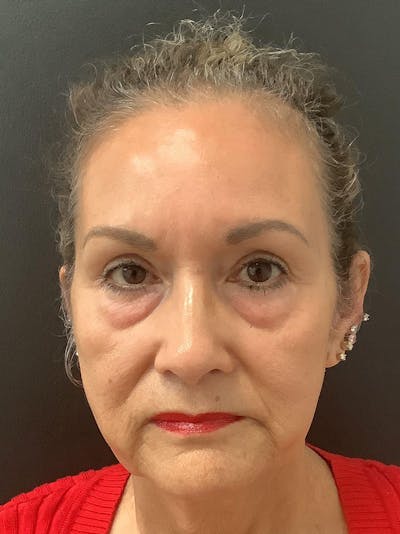 Facelift Before & After Gallery - Patient 123717964 - Image 1