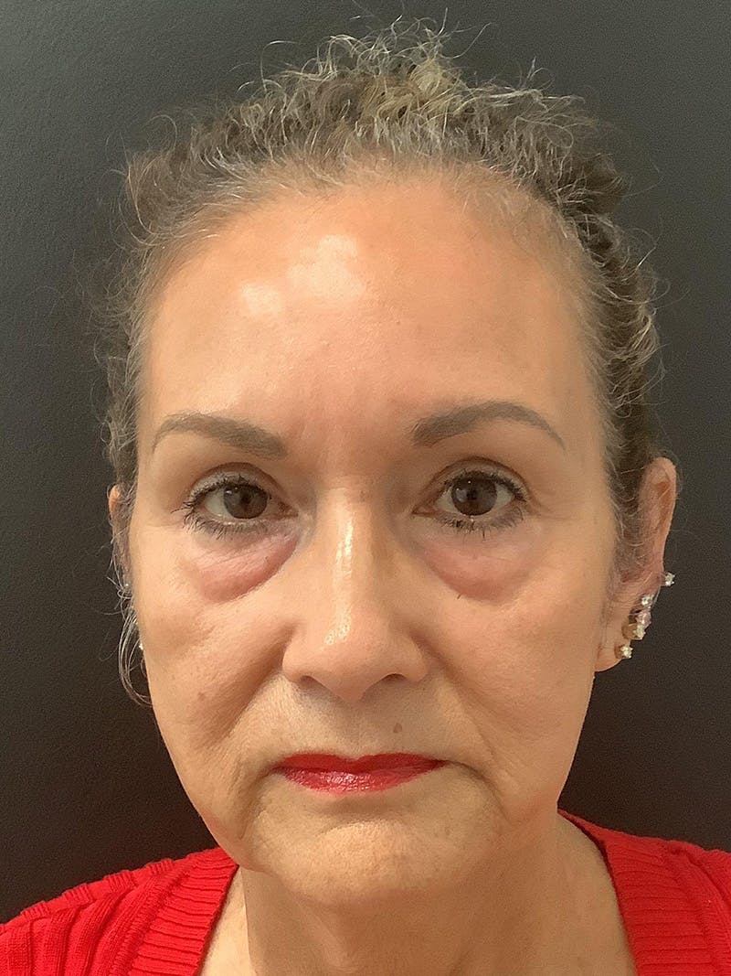 Facelift Before & After Gallery - Patient 123717964 - Image 1