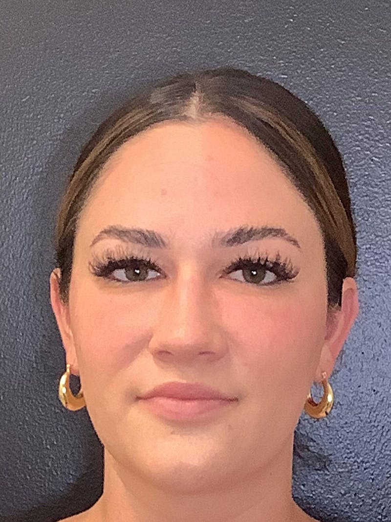 Facial fat transfer patient
