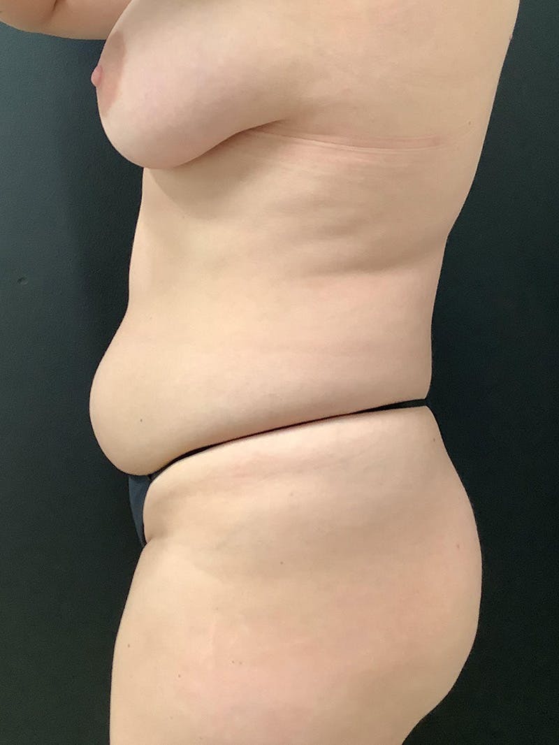 Liposuction Gallery - Patient 123718371 - Image 3