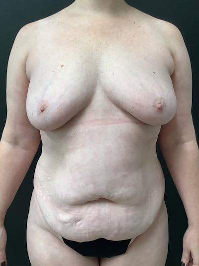 Liposuction Before & After Gallery - Patient 145104978 - Image 1