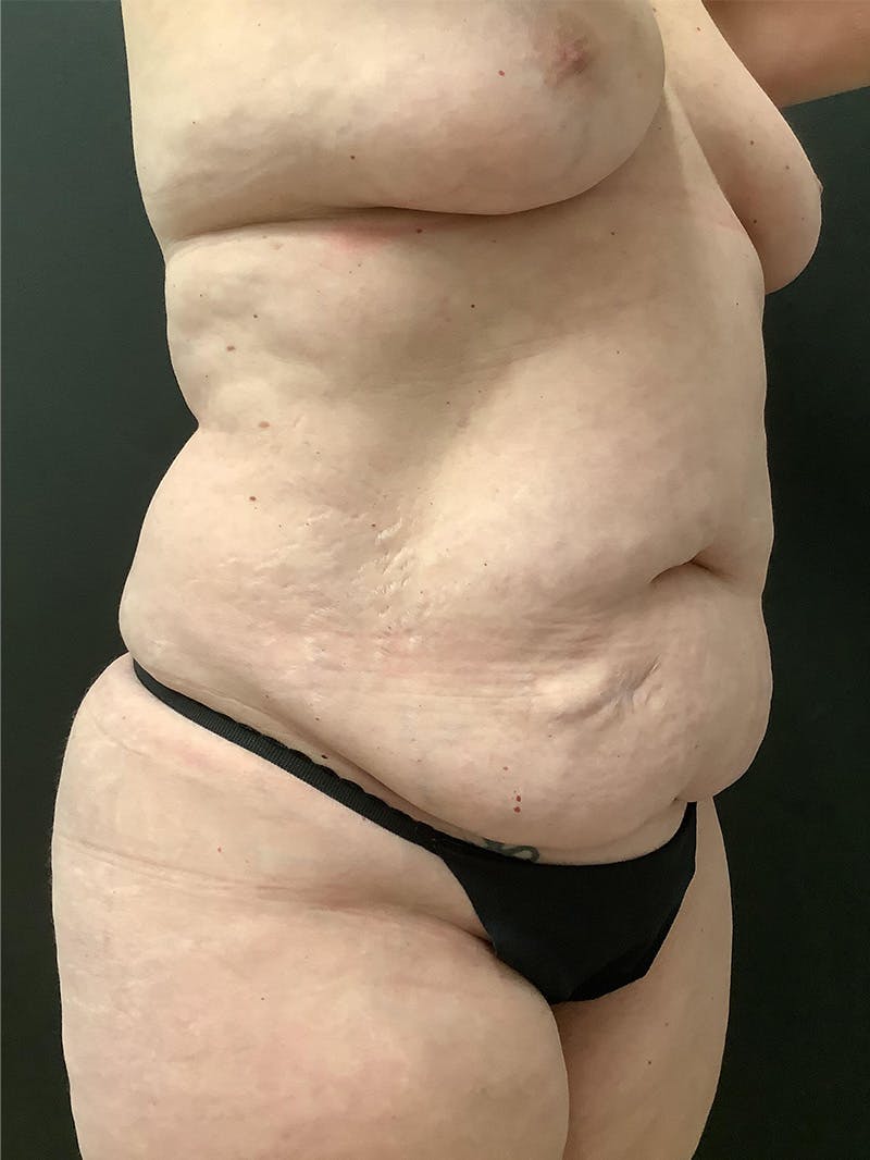 Abdominoplasty Before & After Gallery - Patient 145104977 - Image 3