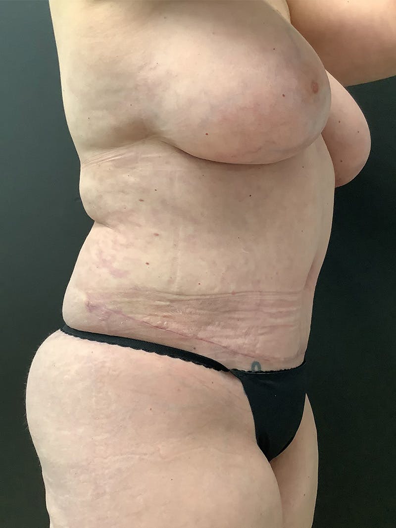 Abdominoplasty Before & After Gallery - Patient 145104977 - Image 4
