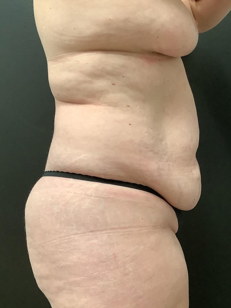 Liposuction Before & After Gallery - Patient 145104978 - Image 5