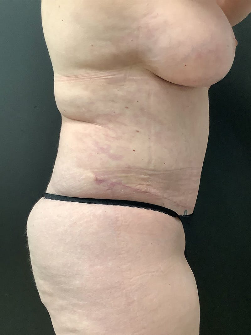 Abdominoplasty Before & After Gallery - Patient 145104977 - Image 6