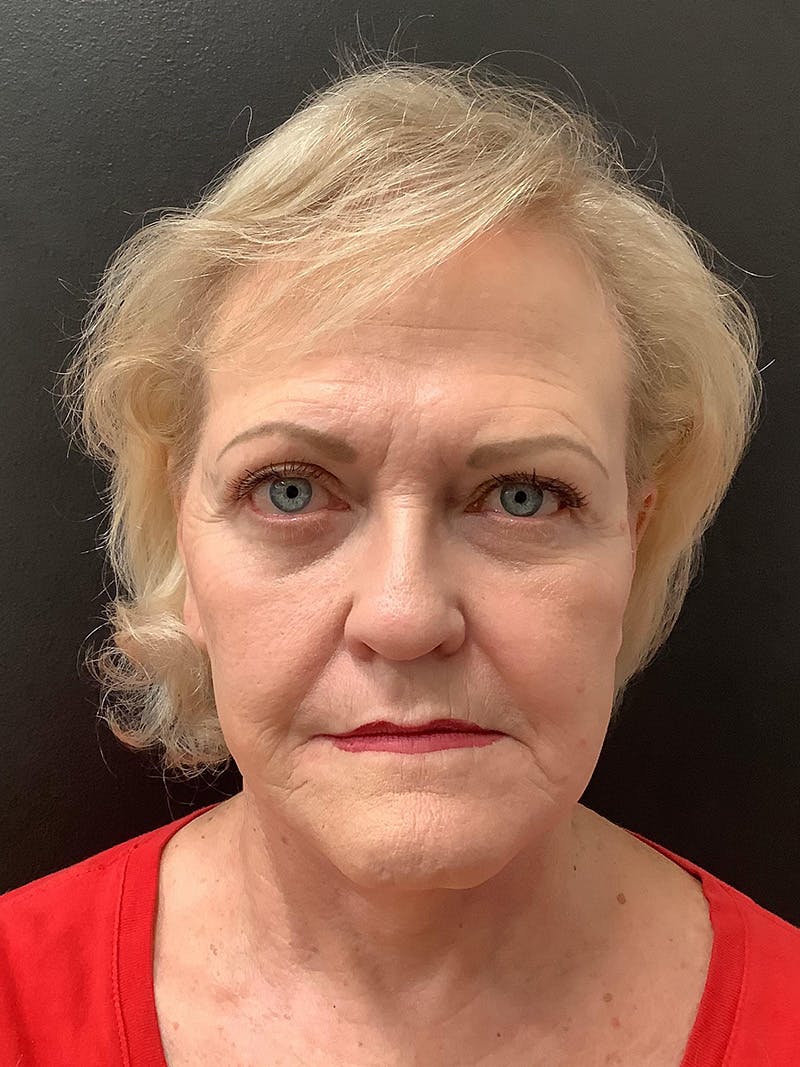 Facelift Before & After Gallery - Patient 145104982 - Image 2