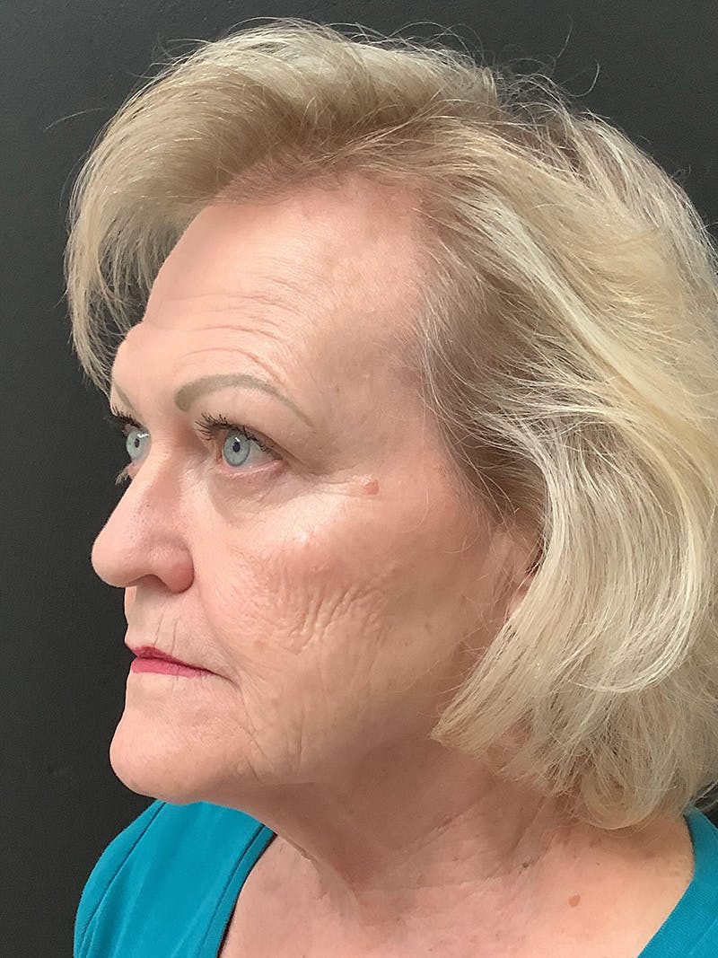 Facelift Before & After Gallery - Patient 145104982 - Image 3