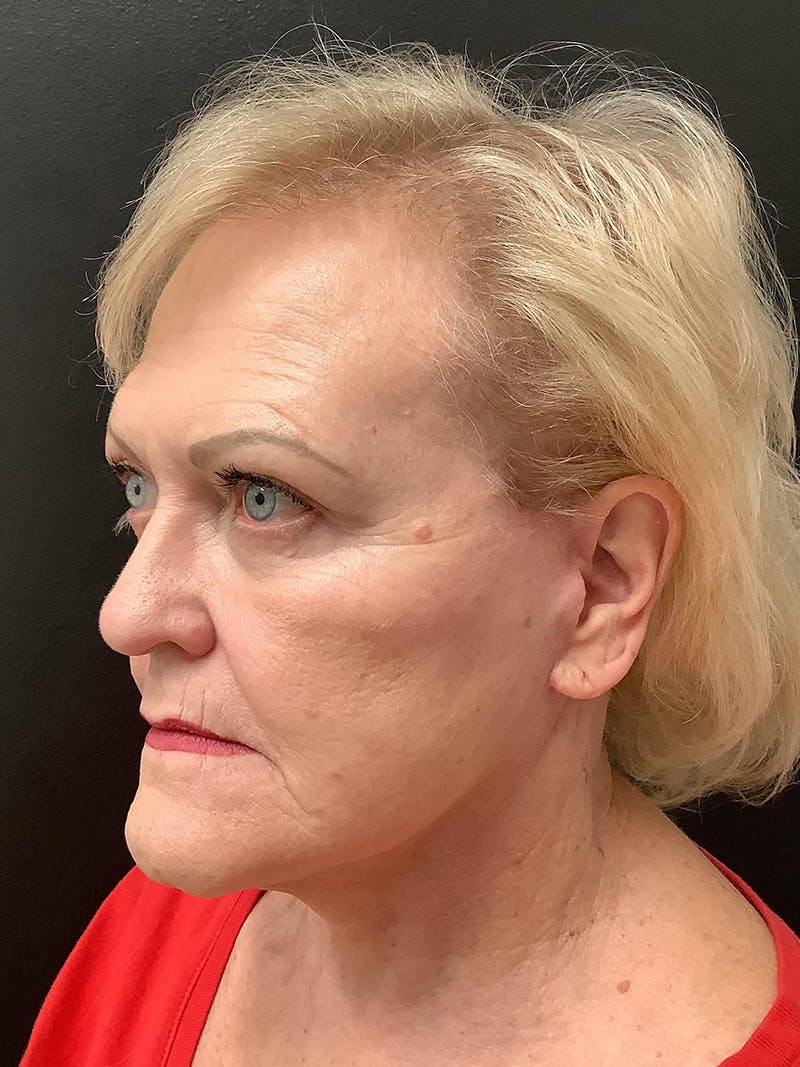 Facelift Before & After Gallery - Patient 145104982 - Image 4