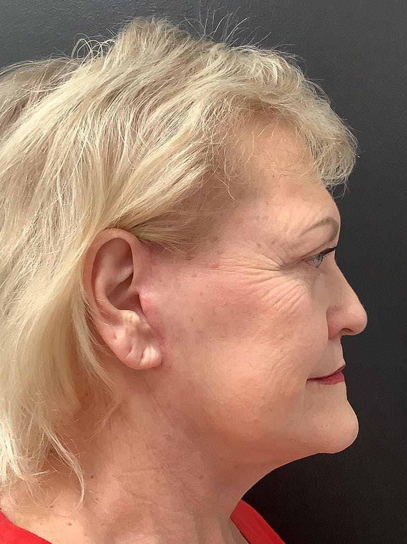 Facelift Before & After Gallery - Patient 145104982 - Image 6