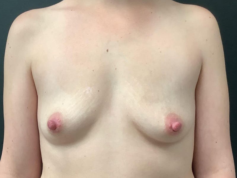 Breast Augmentation Before & After Gallery - Patient 145104986 - Image 1