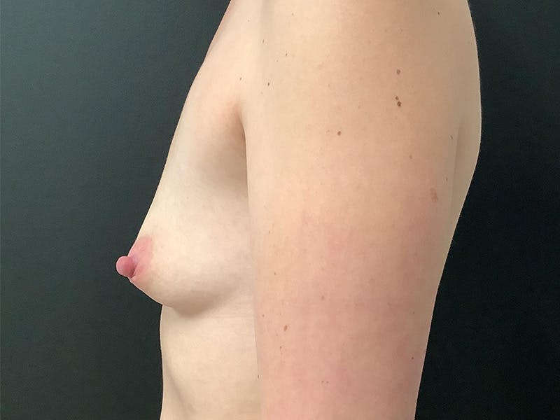 Breast Augmentation Before & After Gallery - Patient 145104986 - Image 5