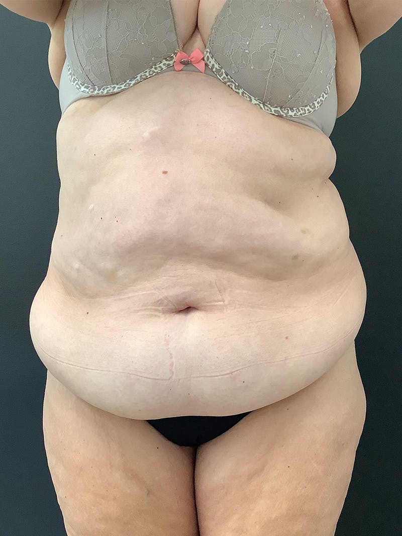 Abdominoplasty Before & After Gallery - Patient 145104988 - Image 1