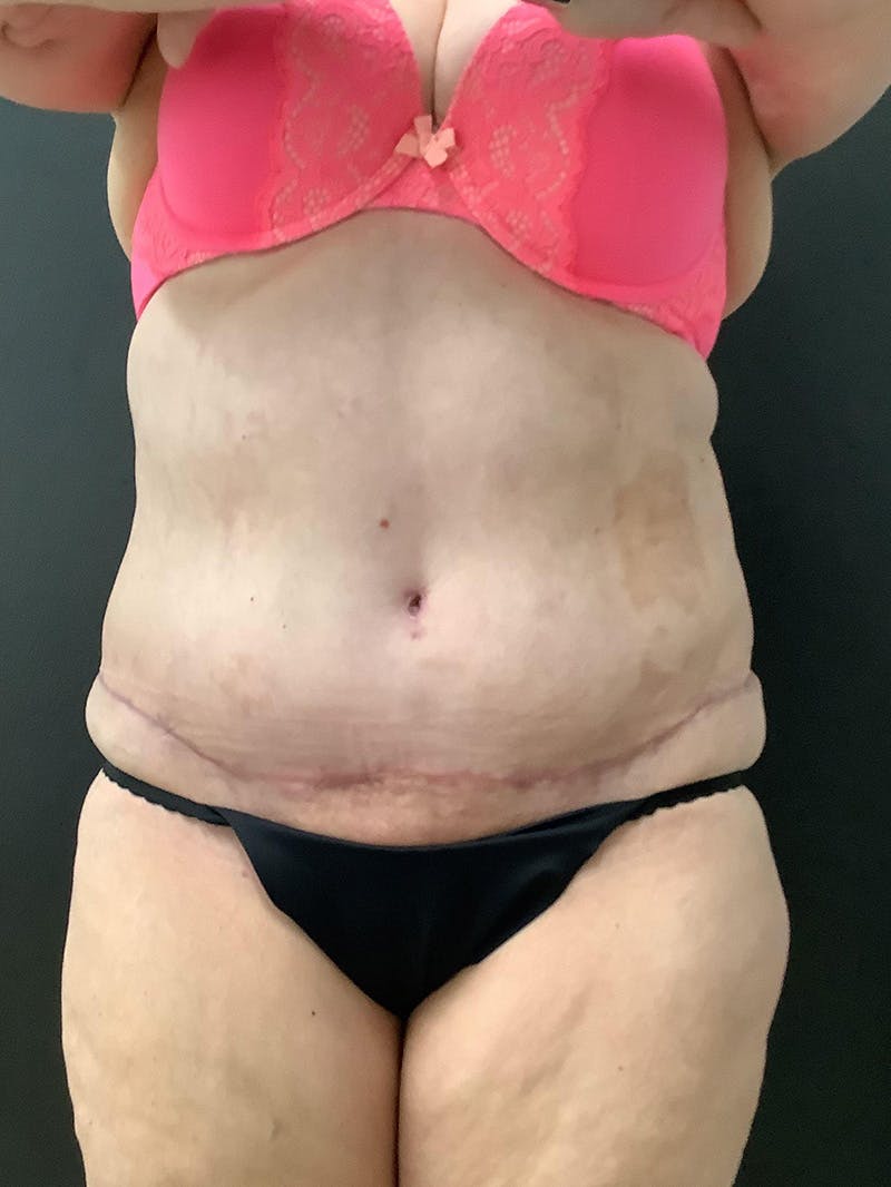 Abdominoplasty Before & After Gallery - Patient 145104988 - Image 2