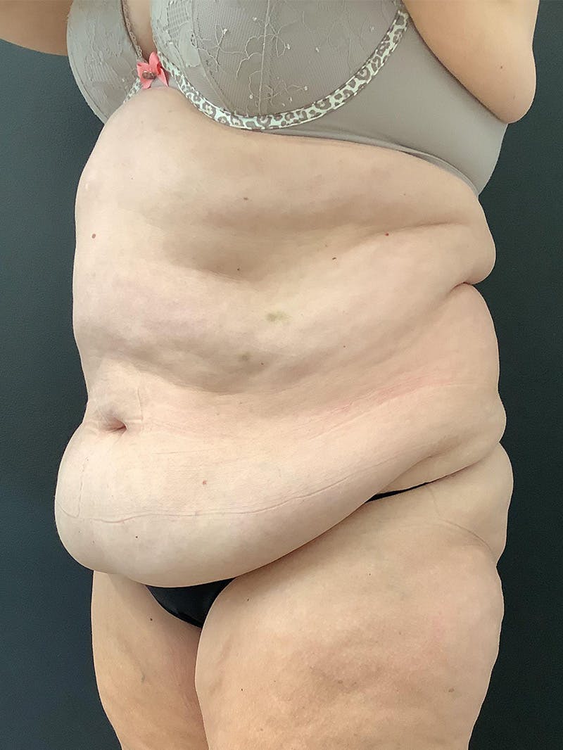 Abdominoplasty Before & After Gallery - Patient 145104988 - Image 3