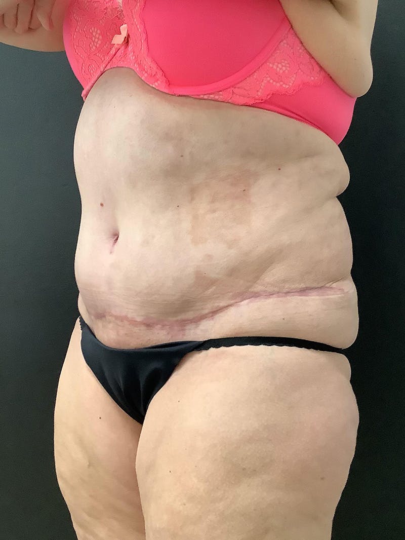 Abdominoplasty Before & After Gallery - Patient 145104988 - Image 4