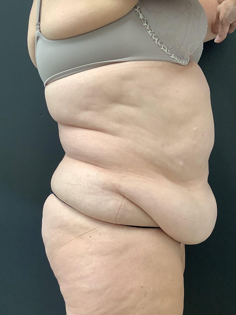 Abdominoplasty Before & After Gallery - Patient 145104988 - Image 5