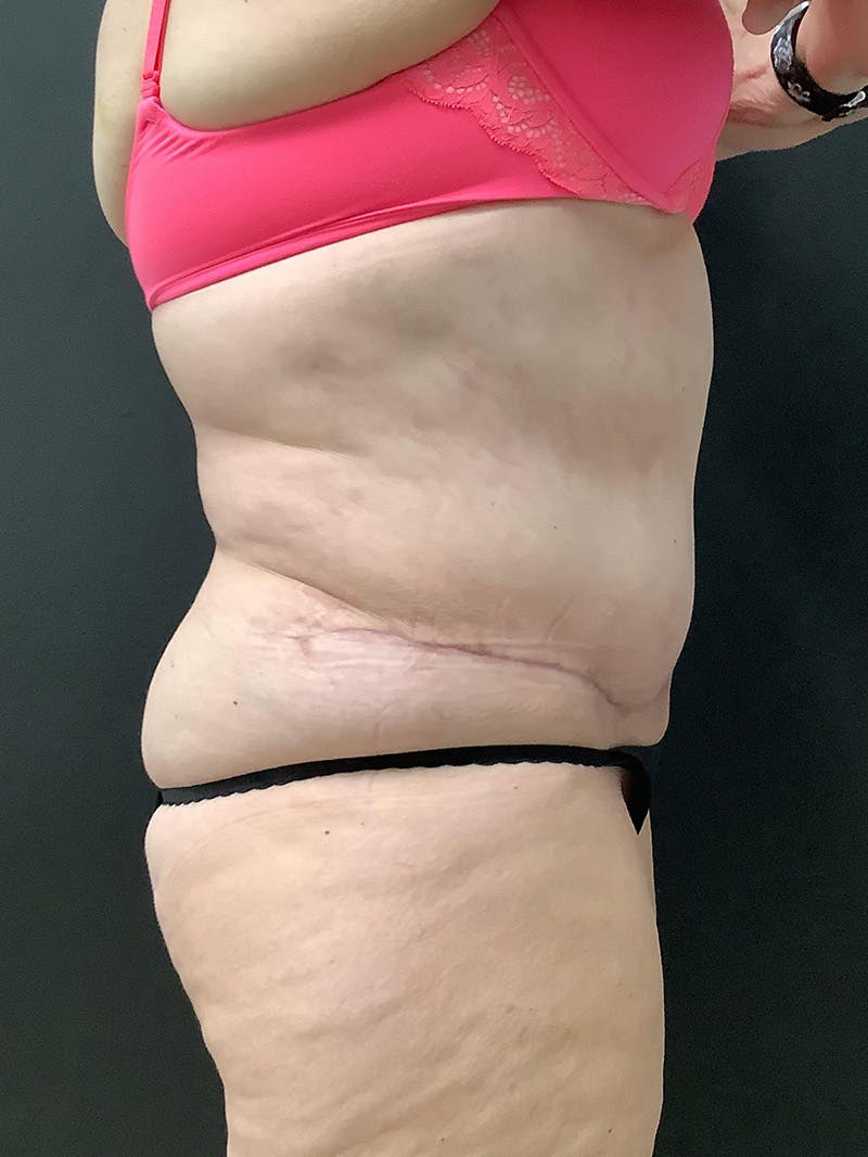 Liposuction Before & After Gallery - Patient 145104989 - Image 6