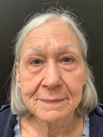 Facial Fat Transfer Before & After Gallery - Patient 145104995 - Image 1