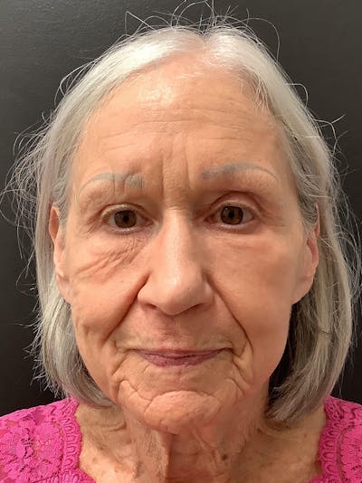 Facial Fat Transfer Before & After Gallery - Patient 145104995 - Image 2