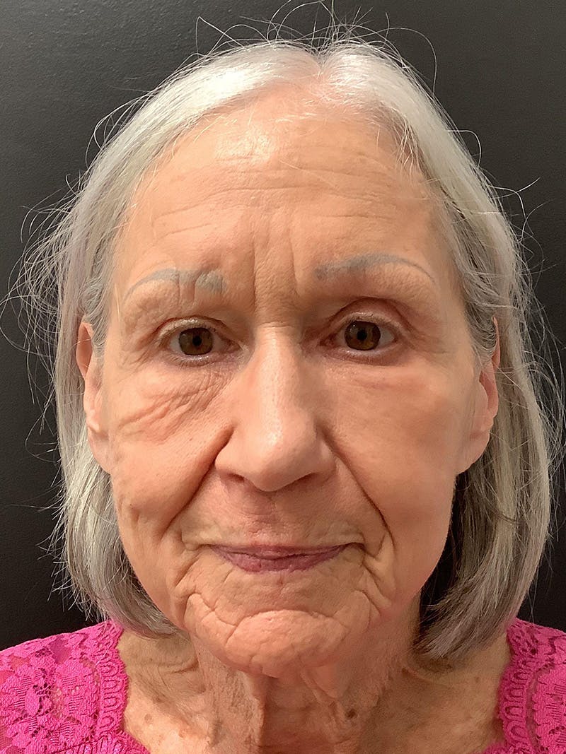 Facial Fat Transfer Before & After Gallery - Patient 145104995 - Image 2