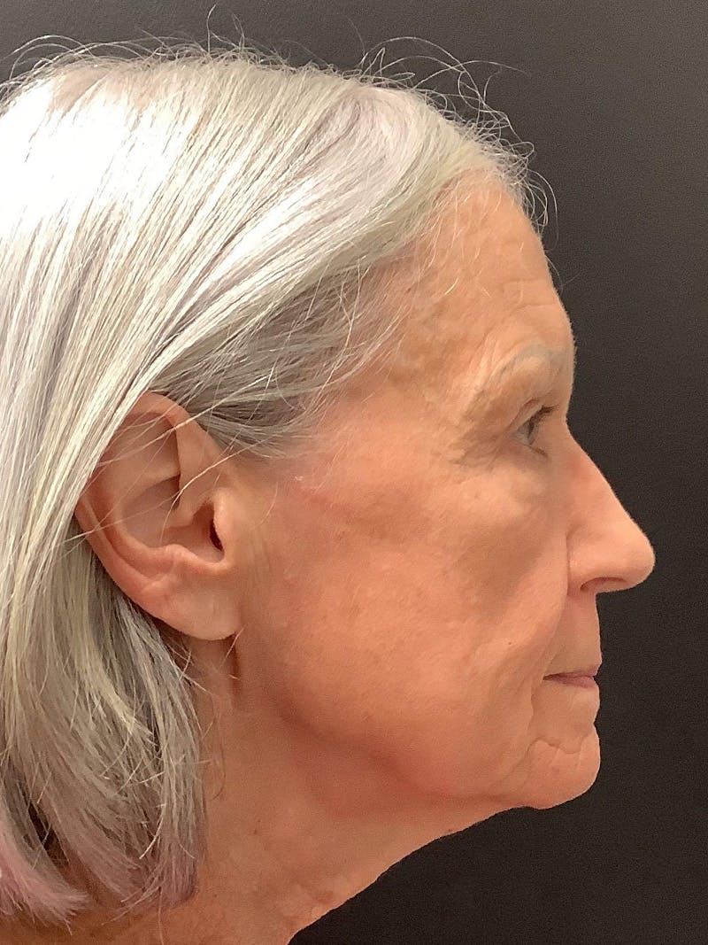 Facial Fat Transfer Before & After Gallery - Patient 145104995 - Image 6
