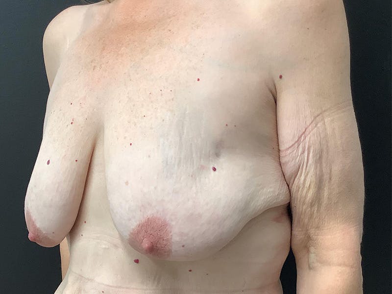 Breast Lift Before & After Gallery - Patient 145105001 - Image 3