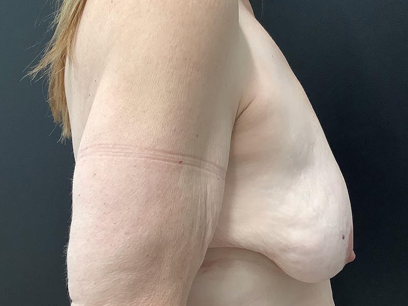 Breast Lift Before & After Gallery - Patient 145105001 - Image 5