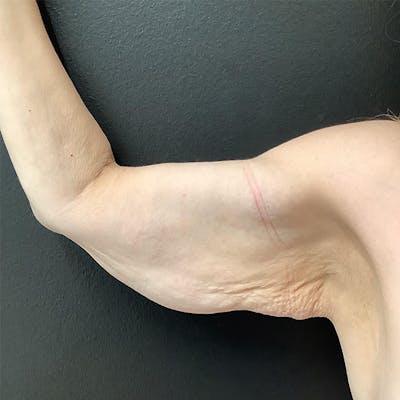 Arm Lift Before & After Gallery - Patient 145105014 - Image 1