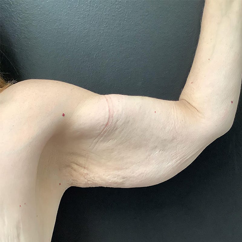 Arm Lift Before & After Gallery - Patient 145105014 - Image 3