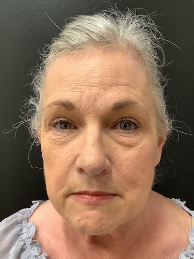 Facelift Before & After Gallery - Patient 145105026 - Image 1