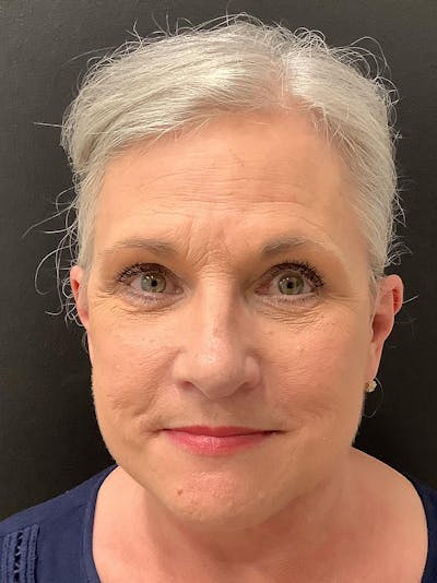 Facelift Before & After Gallery - Patient 145105026 - Image 2