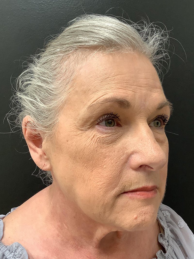 Facelift Before & After Gallery - Patient 145105026 - Image 3