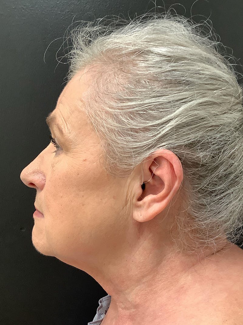 Facelift Before & After Gallery - Patient 145105026 - Image 5