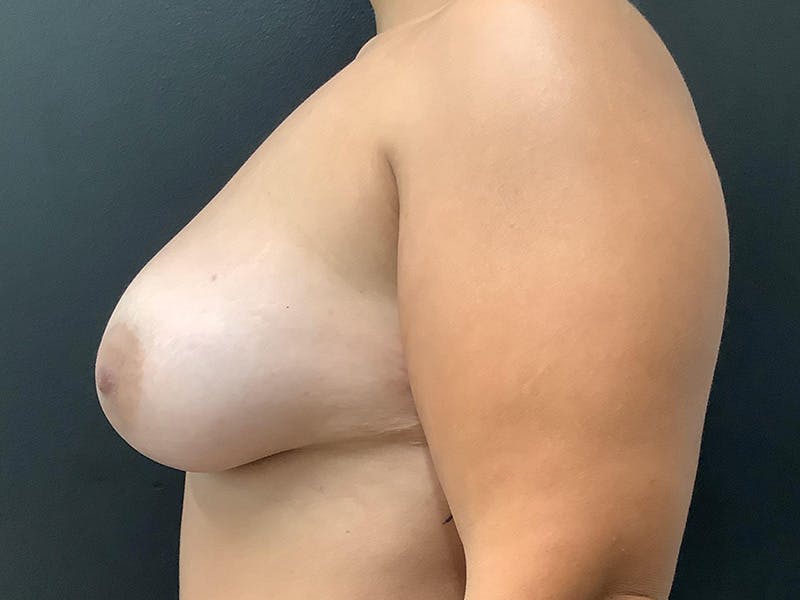 Breast Augmentation Before & After Gallery - Patient 145105052 - Image 6