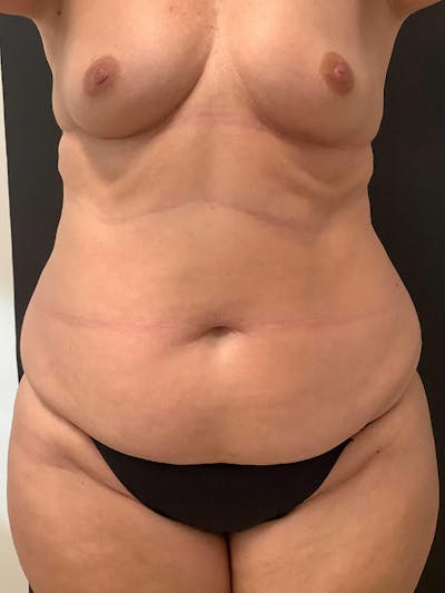 Abdominoplasty Before & After Gallery - Patient 145105058 - Image 1