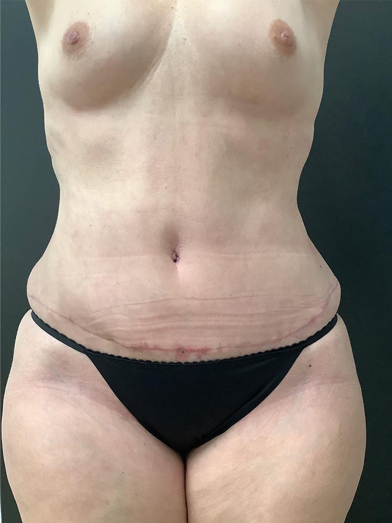 Abdominoplasty Before & After Gallery - Patient 145105058 - Image 2