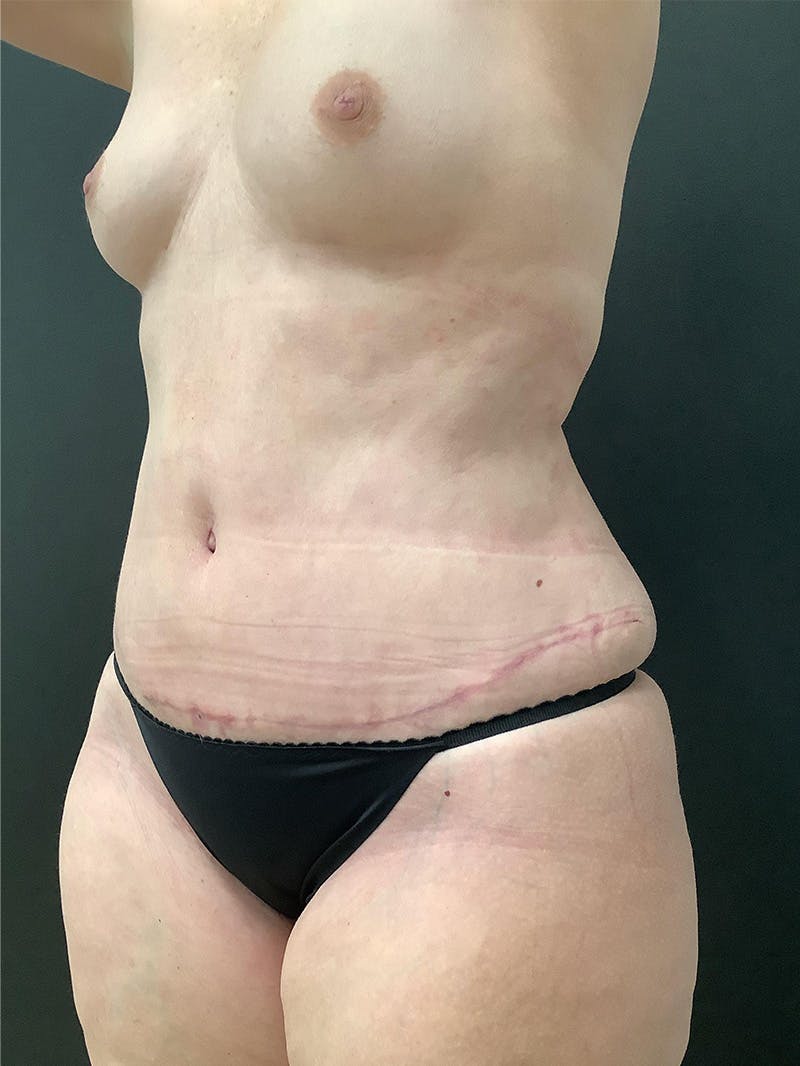 Abdominoplasty Before & After Gallery - Patient 145105058 - Image 4