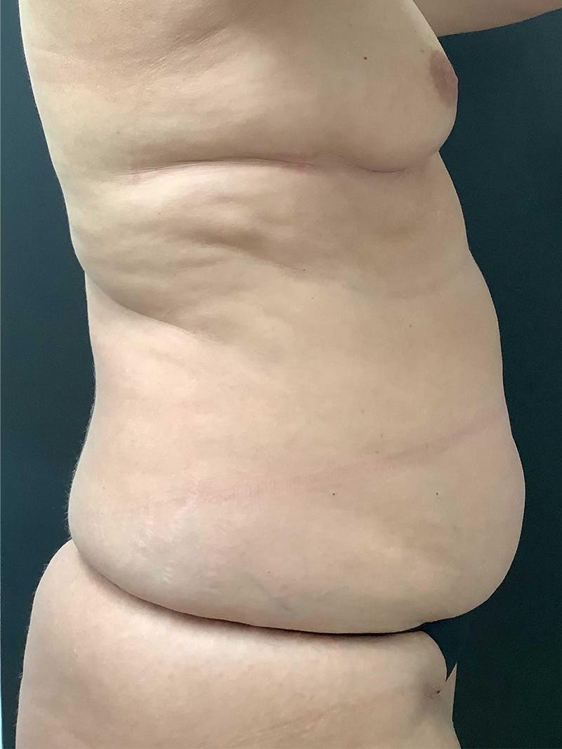 Abdominoplasty Before & After Gallery - Patient 145105058 - Image 5