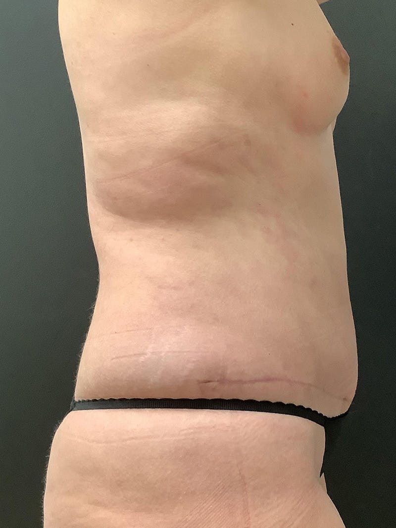 Abdominoplasty Before & After Gallery - Patient 145105058 - Image 6