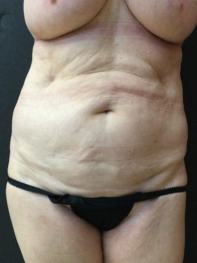 Liposuction Before & After Gallery - Patient 147538175 - Image 1