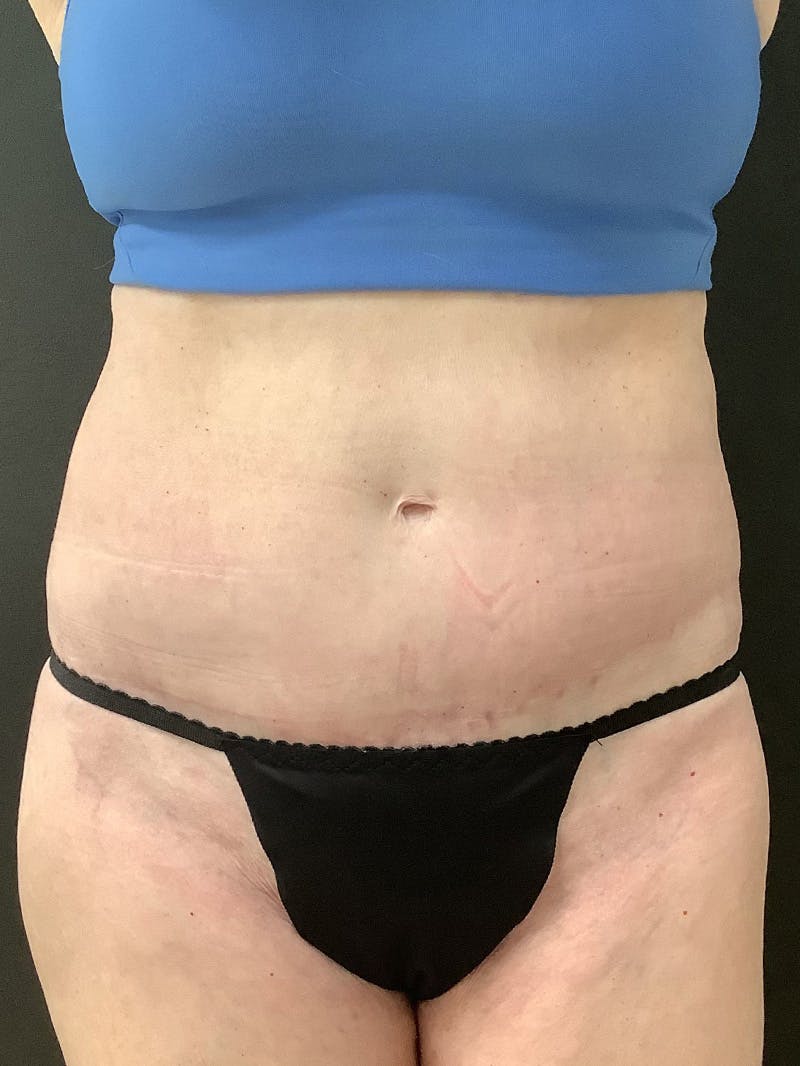 Liposuction Before & After Gallery - Patient 147538175 - Image 2