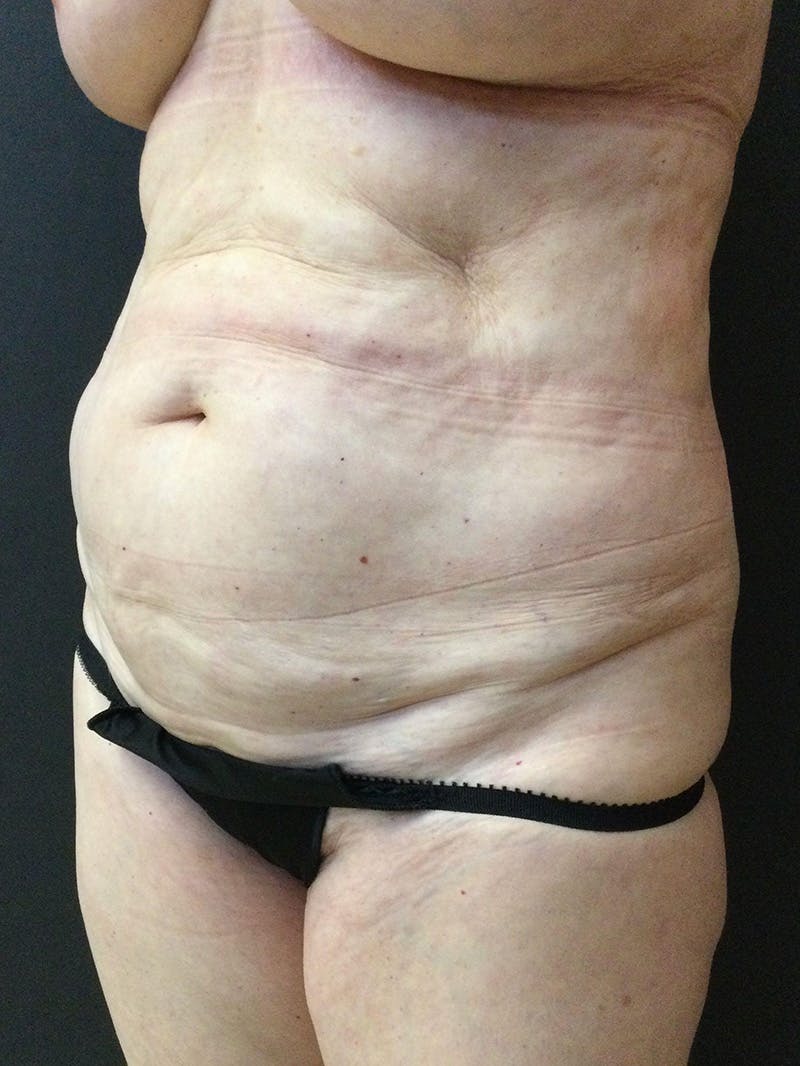 Abdominoplasty Before & After Gallery - Patient 147538174 - Image 3