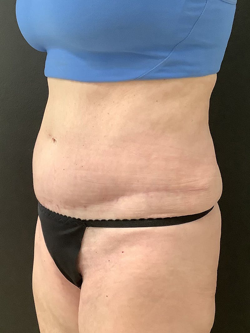 Abdominoplasty Before & After Gallery - Patient 147538174 - Image 4