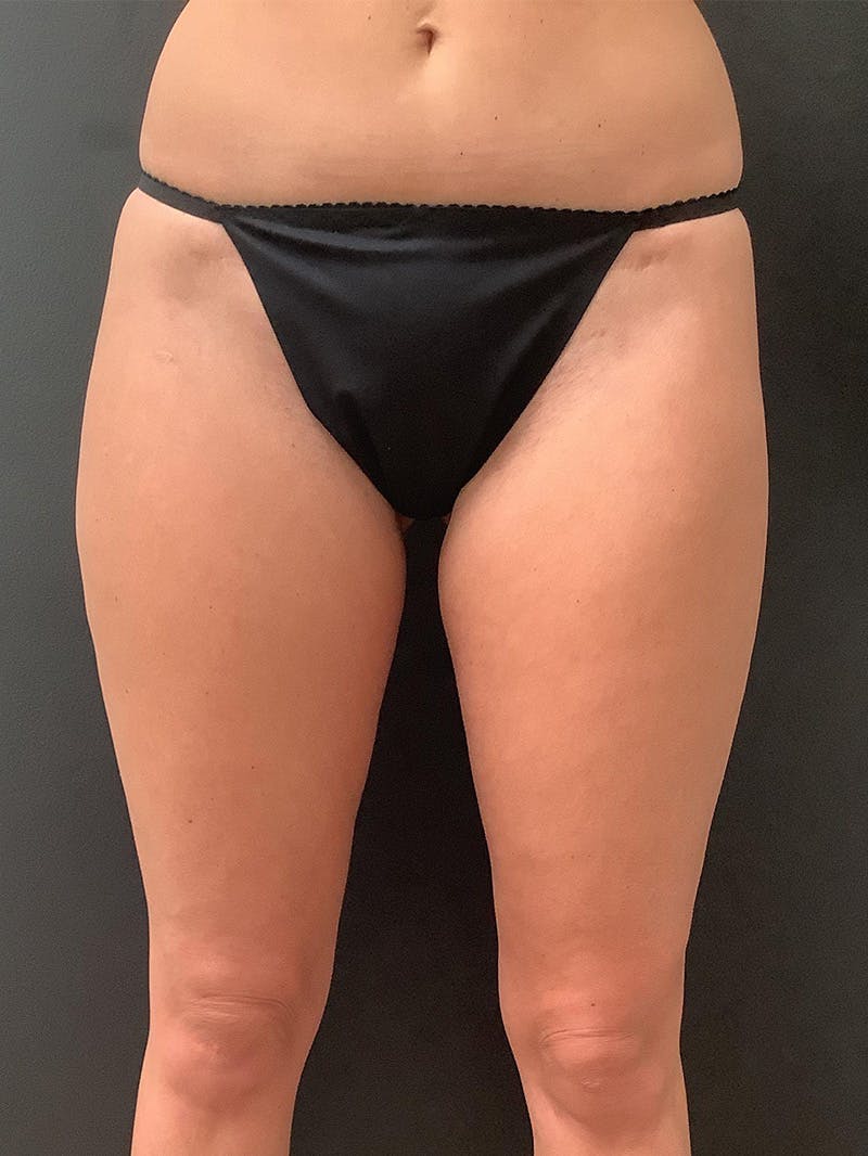 Liposuction Before & After Gallery - Patient 147538205 - Image 1