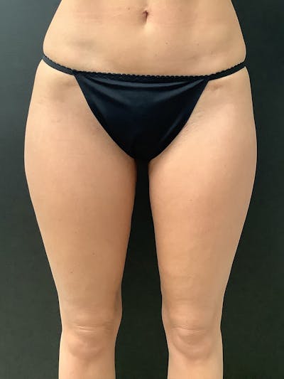 Liposuction Before & After Gallery - Patient 147538205 - Image 2