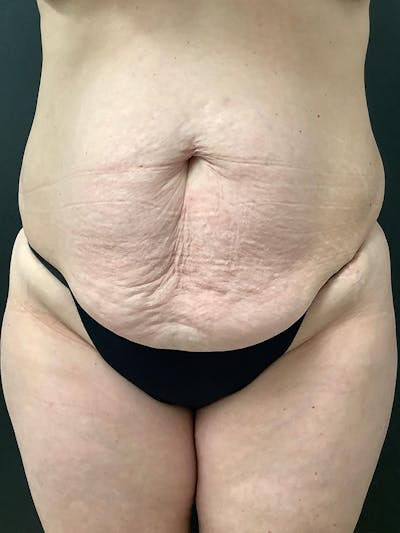 Liposuction Before & After Gallery - Patient 190250 - Image 1