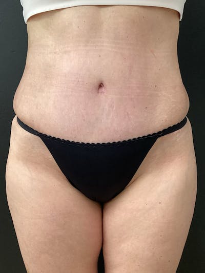 Liposuction Before & After Gallery - Patient 190250 - Image 2