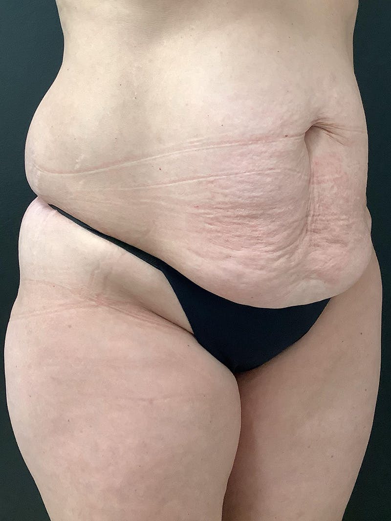 Abdominoplasty Before & After Gallery - Patient 311557 - Image 3