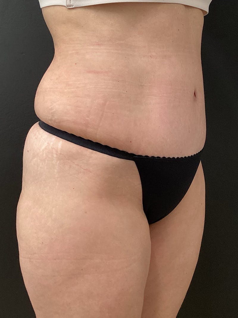 Liposuction Before & After Gallery - Patient 190250 - Image 4